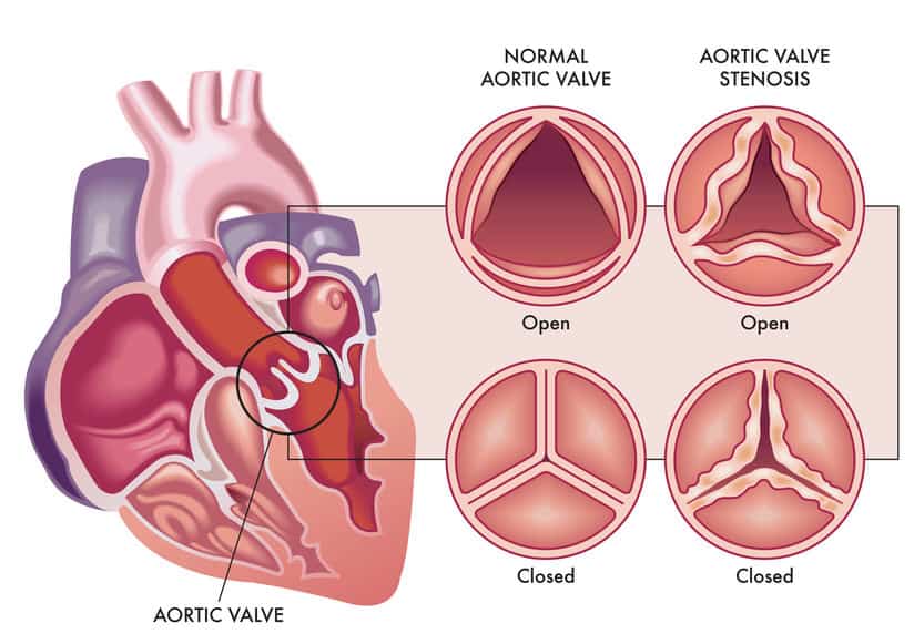 lipoproteína (a)